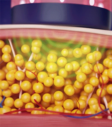 animation-discharges.gif